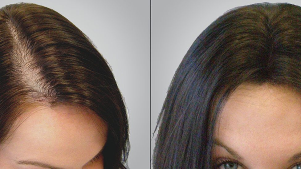 alopecia feminina