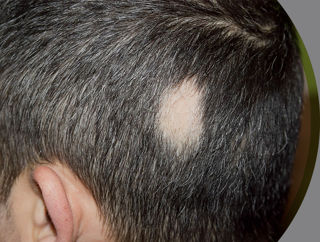 tratamento para alopecia