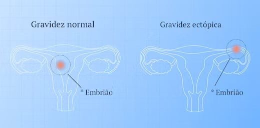 Gravidez Ectópica Tudo O Que Você Precisa Saber 